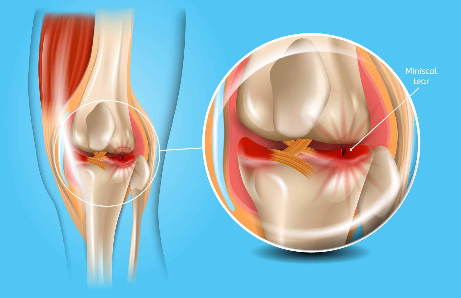 torn meniscus pain